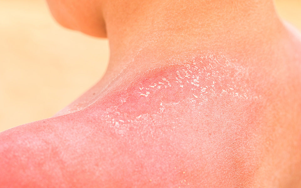 What You Should Know About Sun Poisoning